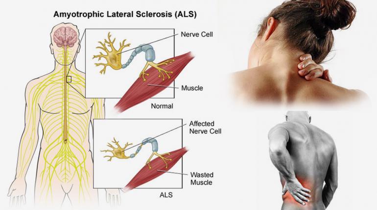 ALS หรือ โรค Amyotrophic lateral sclerosis 