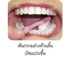 ฟันกรามล่างด้านลิ้นปัดแปรงขึ้น