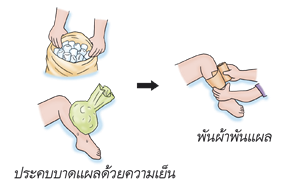 ประคบบาดแผลด้วยความเย็น พันผ้าพันแผล